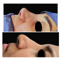 عمل زیبایی بینی، رینوپلاستی (شوش)|خدمات آرایشگری و زیبایی|شوش, |دیوار