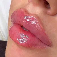 تزریق ژل لب روسی آنزیم زاویه سازی لیزر توسط پزشک