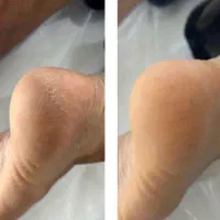 رفع تیرگی بدن در مطب پزشکی با دستگاه|خدمات آرایشگری و زیبایی|شیراز, قدوسی غربی|دیوار