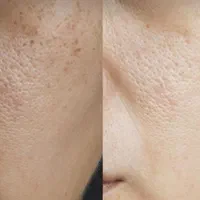 لیزر کک مک خال لیفت لمینت پاکسازی مژه ناخن ژل|خدمات آرایشگری و زیبایی|خرم‌آباد, |دیوار
