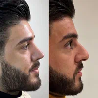 جراحی زیبائی بینی عمل بینی لیفت شقیقه پلک گوش غبغب|خدمات آرایشگری و زیبایی|اصفهان, مرداویج|دیوار