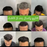 کاشت مو تراکم بالا (بدون تراشیدن سر)|خدمات آرایشگری و زیبایی|محمدشهر, |دیوار