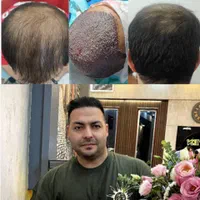 کاشت ابرو وموی طبیعی|خدمات آرایشگری و زیبایی|بوشهر, |دیوار