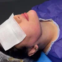 ساکشن شکم .غبغب .تزریق چربی .فیلر.پهلوتوسط پزشک