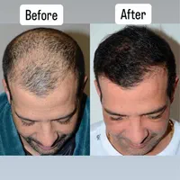 کاشت مو و ابرو و انجام بوتاکس و مزوتراپی و PRP|خدمات آرایشگری و زیبایی|قزوین, |دیوار