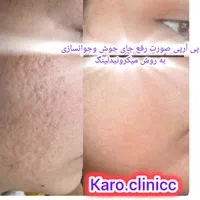 پی آرپی مو وصورت وبوتاکس آف خورده