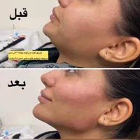 جشنواره تزریق ژل و بوتاکس،فیلرلب،مزو،هایفو،آنزیم|خدمات آرایشگری و زیبایی|کرج, عظیمیه|دیوار