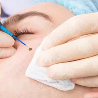 برداشتن خال،چربی و حذف گوشت اضافی توسط پزشک