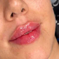 جشنواره تزریق ژل و بوتاکس مزوتراپی مزوژل|خدمات آرایشگری و زیبایی|شیراز, تحویلی|دیوار