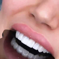 کامپوزیت دندان ، اصلاح طرح لبخند|خدمات آرایشگری و زیبایی|اصفهان, خواجو|دیوار