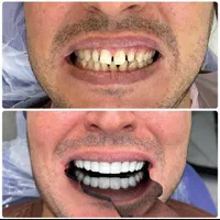 آفرلمینت‌دندان‌وروکش|خدمات آرایشگری و زیبایی|تهران, شهرک ولیعصر جنوبی|دیوار