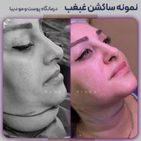 رفع و ساکشن غبغب 100% تضمین کتبی|خدمات آرایشگری و زیبایی|تهران, صادقیه|دیوار