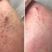 پاکسازی تخصصی پوست آقایان و بانوان|خدمات آرایشگری و زیبایی|گلستان (تهران), |دیوار