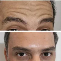 جشنواره نوروزمدل ژل وبوتاکس هایفو تراپی مزوتراپی ‌|خدمات آرایشگری و زیبایی|تهران, تهرانپارس شرقی|دیوار