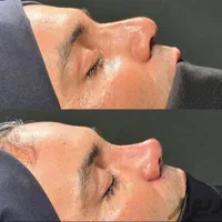 بلفاروپلاستی ،سانترال لب،لیفت ابرو،چربی صورت|خدمات آرایشگری و زیبایی|تهران, هروی|دیوار
