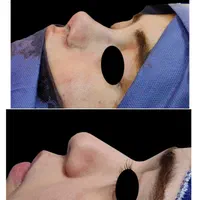 عمل زیبایی بینی(شوش)|خدمات آرایشگری و زیبایی|شوش, |دیوار