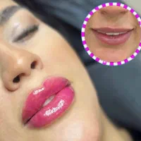 تزریق ژل و بوتاکس هایفو فیلربادی|خدمات آرایشگری و زیبایی|تهران, عبدل‌آباد|دیوار
