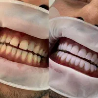 جشنواره کامپوزیت دندان|خدمات آرایشگری و زیبایی|فردیس, فردیس|دیوار