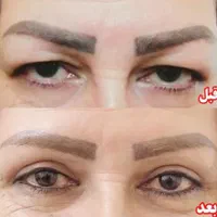 عمل بلفاروپلاستی درمان افتادگی پلک توسط متخصص چشم|خدمات آرایشگری و زیبایی|یاسوج, |دیوار