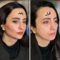 ژل لب بوتاکس لیزر فیلر هایفوبلفاروپلاستی|خدمات آرایشگری و زیبایی|مشهد, فرهنگ|دیوار