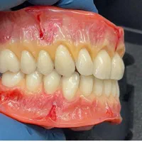 دندان مصنوعی باجدیدترین متد جهانی بدونه لقی|خدمات آرایشگری و زیبایی|شهرکرد, |دیوار