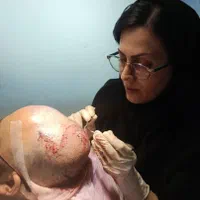 کاشت مو ، ریش و ابرو|استخدام درمانی، زیبایی، بهداشتی|شیراز, بعثت|دیوار