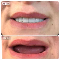 روکش/وینر/لمینت/عصبکشی/خدمات دندانپزشکی ِ|خدمات آرایشگری و زیبایی|تبریز, |دیوار