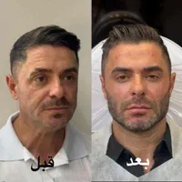 آموزش و خدمات ژل فیلر بوتاکس هایفو توسط پزشک مجرب|خدمات آرایشگری و زیبایی|شهریار, |دیوار