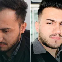 کاشت مو ب روش شیرازی درمشهد|خدمات آرایشگری و زیبایی|مشهد, احمدآباد|دیوار