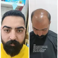 کاشت مو ابرو و ریش تارکوب|خدمات آرایشگری و زیبایی|قم, صفائیه|دیوار