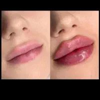 جشنواره پاییزه تزریق ژل وبوتاکس توسط پزشک متخصص|خدمات آرایشگری و زیبایی|بندرعباس, |دیوار