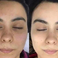 تخفیفات مدل ژل بوتاکس مزو،پاکسازی و جوانسازی صورت|خدمات آرایشگری و زیبایی|مشهد, طلاب|دیوار
