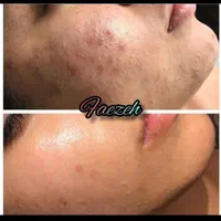 پاکسازی و فیشیال پوست|خدمات آرایشگری و زیبایی|یاسوج, |دیوار