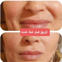 تزریق چربی صورت،ژل،بوتاکس،لیزر،لاغری|خدمات آرایشگری و زیبایی|رشت, گلسار|دیوار