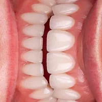 کامپوزیت دندان|خدمات آرایشگری و زیبایی|پاکدشت, خاتون آباد|دیوار