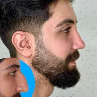 عمل جراحی بینی ۲۴میلیون/بهترین متخصص کرج|خدمات آرایشگری و زیبایی|کرج, فاز ۱ مهرشهر|دیوار