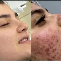 پاکسازی صورت فیشیال پوست تخصصی