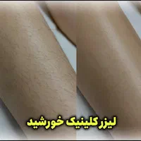 لیزر صورت و بدن آقایان و بانوان در کلینیک|خدمات آرایشگری و زیبایی|پرند, فاز ۲|دیوار
