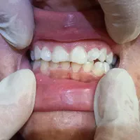 کامپوزیت دندان لمینت ایمپلنت دندانپزشکی عصبکشی|خدمات آرایشگری و زیبایی|شیراز, قصرالدشت|دیوار