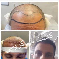 کاشت مو ابرو ریش|خدمات آرایشگری و زیبایی|تهران, جماران (نیاوران)|دیوار
