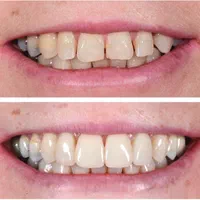 کلینیک تخصصی روکش و روکش ایمپلنت با تضمین کیفیت|خدمات آرایشگری و زیبایی|تبریز, |دیوار