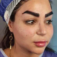 کاشت مو و ابرو زنجان ،مزوتراپی ،prp