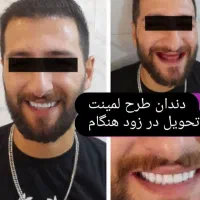 پروتز متحرک طرح لمینت (دندان مصنوعی)تا ۶ ماه اقساط