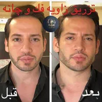 تزریق تخصصی ژل ومادلینگ خلیجی واروپایی وبوتاکس|خدمات آرایشگری و زیبایی|کرمانشاه, |دیوار