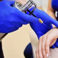 درمان زگیل تناسلی/لیزر/کرایو فریز/hpv/توسط پزشک