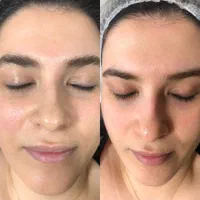 پاکسازی رایگان پوست مطهری|خدمات آرایشگری و زیبایی|رشت, خمیران زاهدان|دیوار