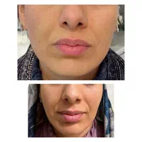 هایفو / لیفت صورت (شوش)|خدمات آرایشگری و زیبایی|شوش, |دیوار