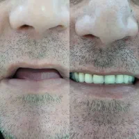 دندانسازی محمدی/طرح کامپوزیت|خدمات آرایشگری و زیبایی|محمدشهر, جعفرآباد|دیوار