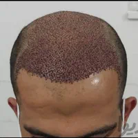 کاشت موی طبیعی به روش fit ،و سوپر sut|خدمات آرایشگری و زیبایی|اهواز, کیانپارس |دیوار