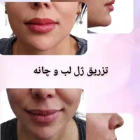 جشنواره تزریق ژل و بوتاکس و PRP برداشت خال|خدمات آرایشگری و زیبایی|تهران, بلوار کشاورز|دیوار